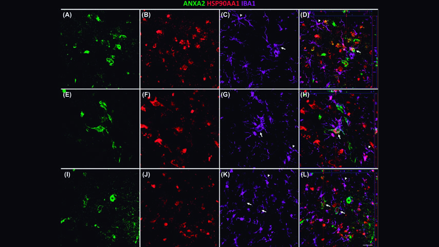 Colocalizacion triple ANXA2, HSP90AA1 y microglía en alzhéimer